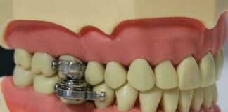 Researchers try magnetic lockjaw to counter obesity